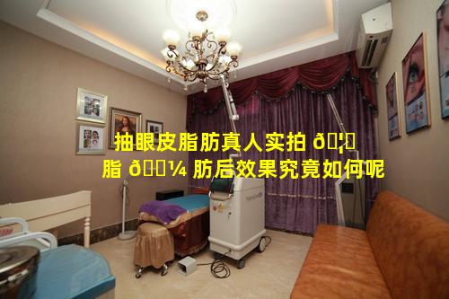 抽眼皮脂肪真人实拍 🦆 脂 🌼 肪后效果究竟如何呢